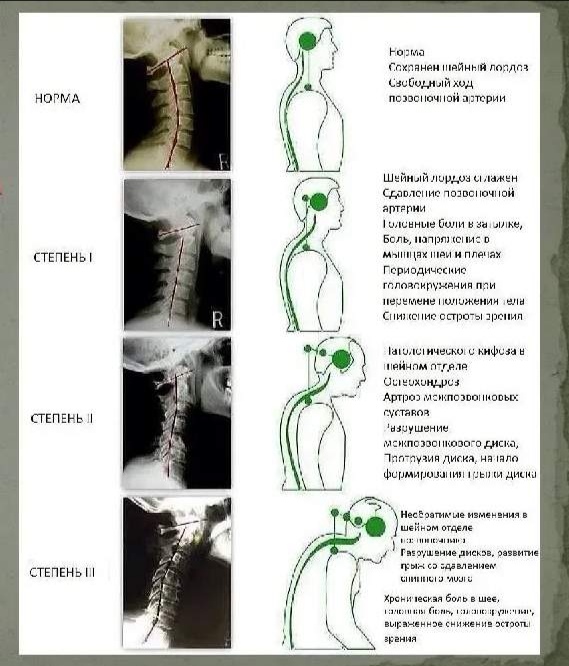 Проблемы с шеей. Первопричины травматизма.